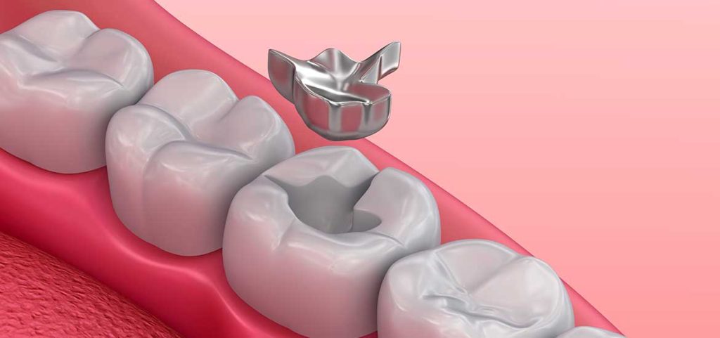 Amalgam