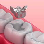Amalgam