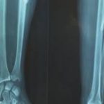 Fracture
