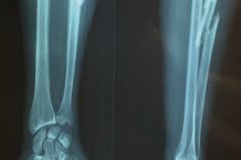 Fracture